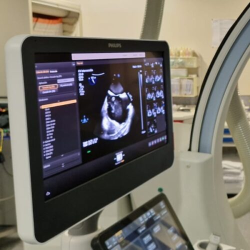 El HUCA realiza la primera intervención del país para la reparación simultánea transcatéter de las válvulas cardíacas tricúspide y mitral