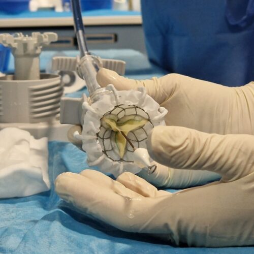 El HUCA implanta por primera vez una válvula tricúspide por vía percutánea