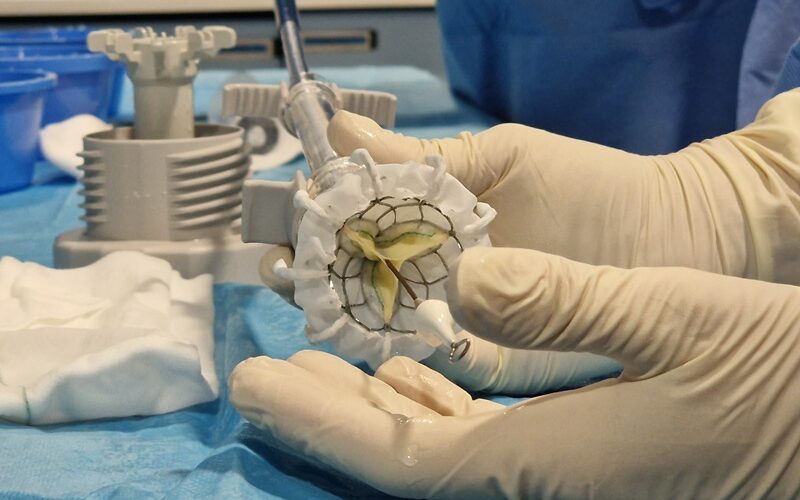 El HUCA implanta por primera vez una válvula tricúspide por vía percutánea