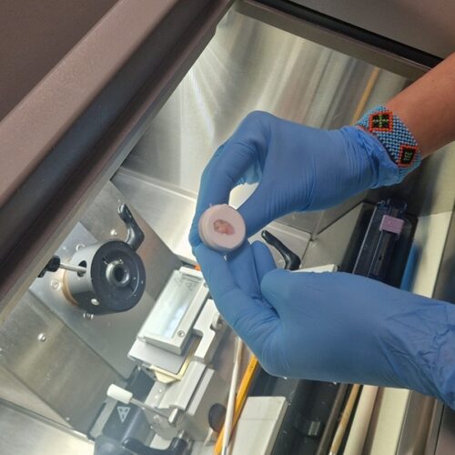 El Hospital Vital Álvarez Buylla consolida la cirugía de Mohs entre sus servicios