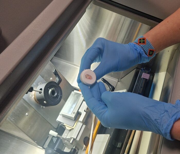 El Hospital Vital Álvarez Buylla consolida la cirugía de Mohs entre sus servicios