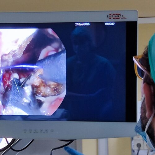 El Hospital Valle del Nalón realiza la primera intervención por vía oral para solucionar complicaciones tras bypass gástrico