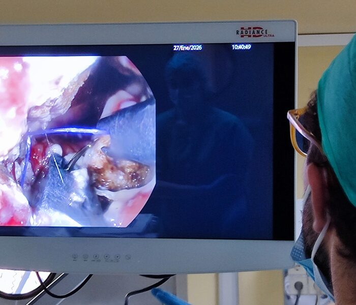 El Hospital Valle del Nalón realiza la primera intervención por vía oral para solucionar complicaciones tras bypass gástrico